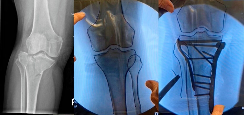 Introducing a technique for intraoperative assessment of fracture reduction: the "transparency film method"