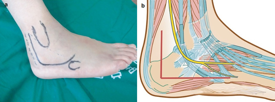 calcaneal fractures with plate and screw