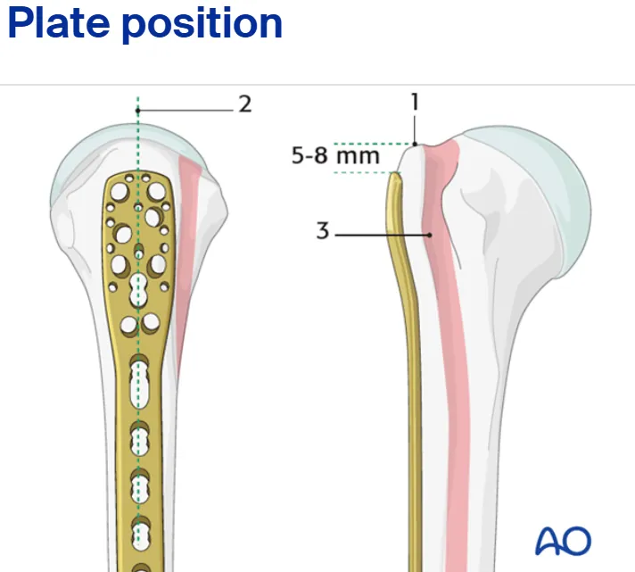 internal fixation surgery of proximal humeral fracture