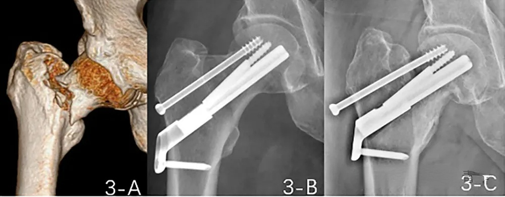 femoral neck fractures