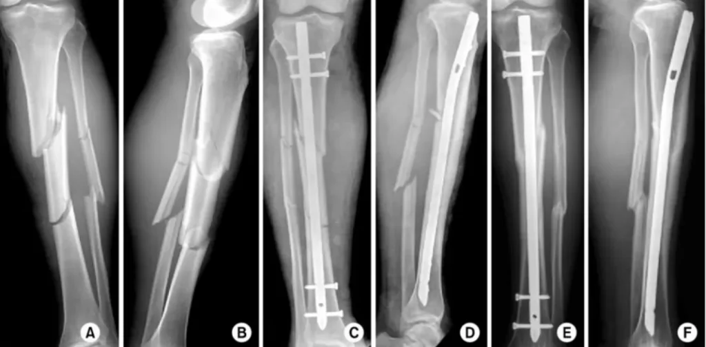 tibial fractures