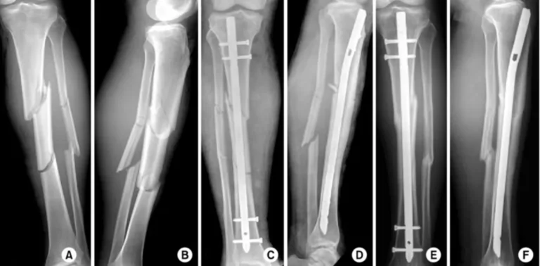 tibial fractures