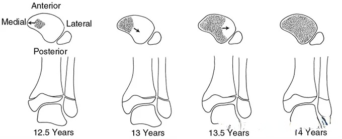 distal tibial physeal closure