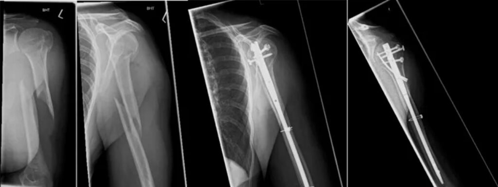 Humeral Shaft Fractures