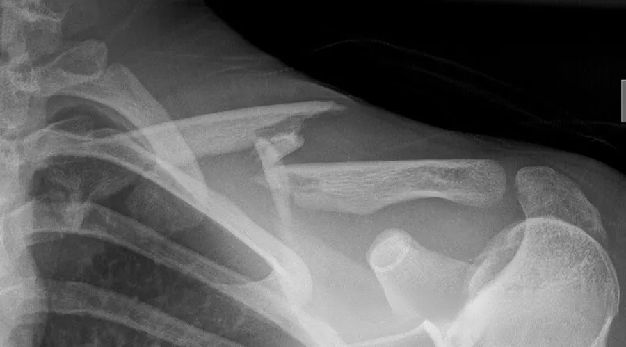 fractured clavicle