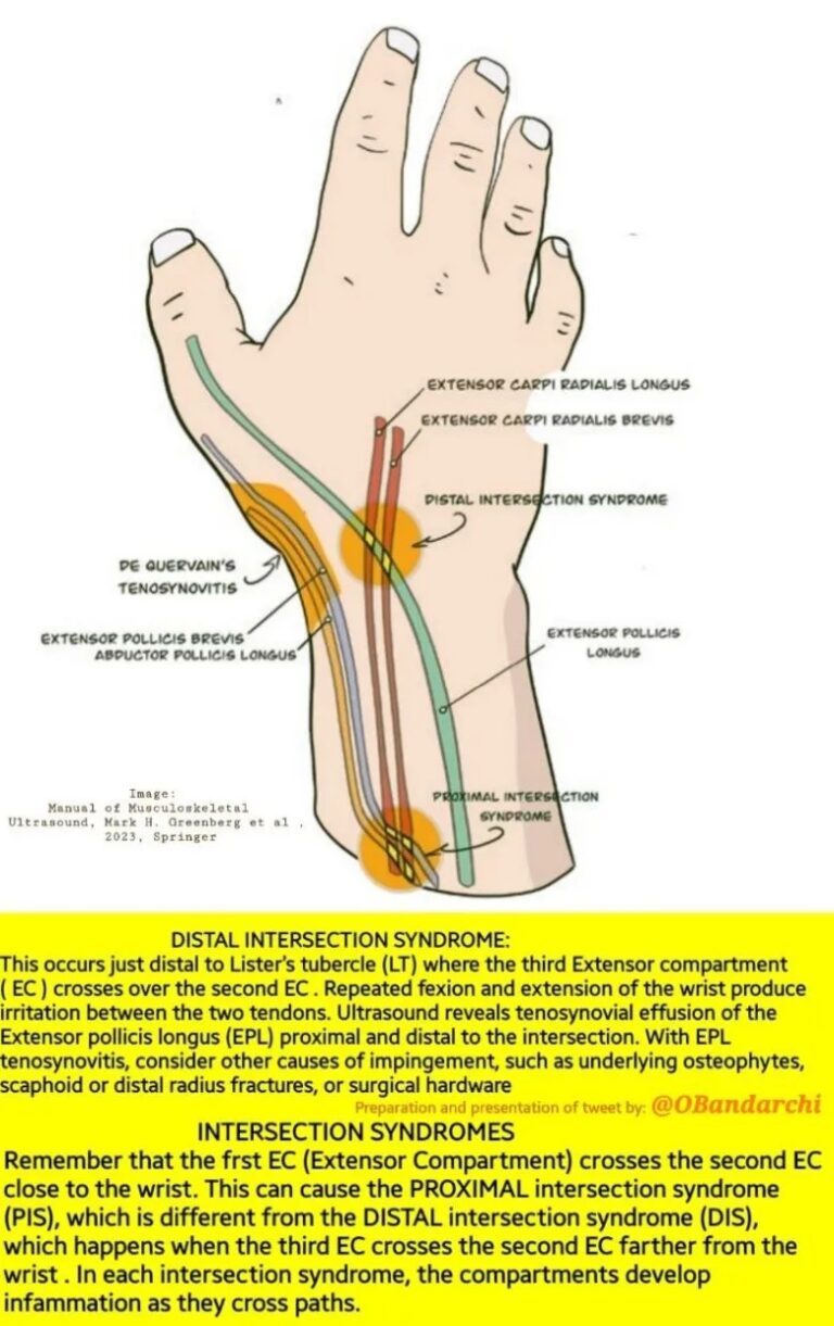 A Comprehensive Guide to Intersection Syndromes: Distal vs. Proximal Intersection Syndrome