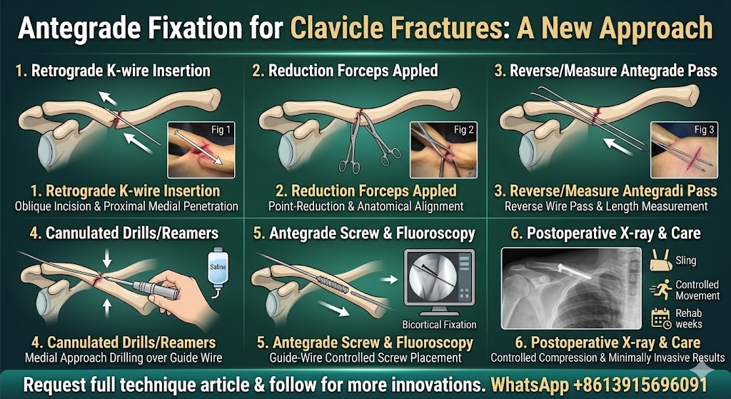 Clavicular Shaft Fractures