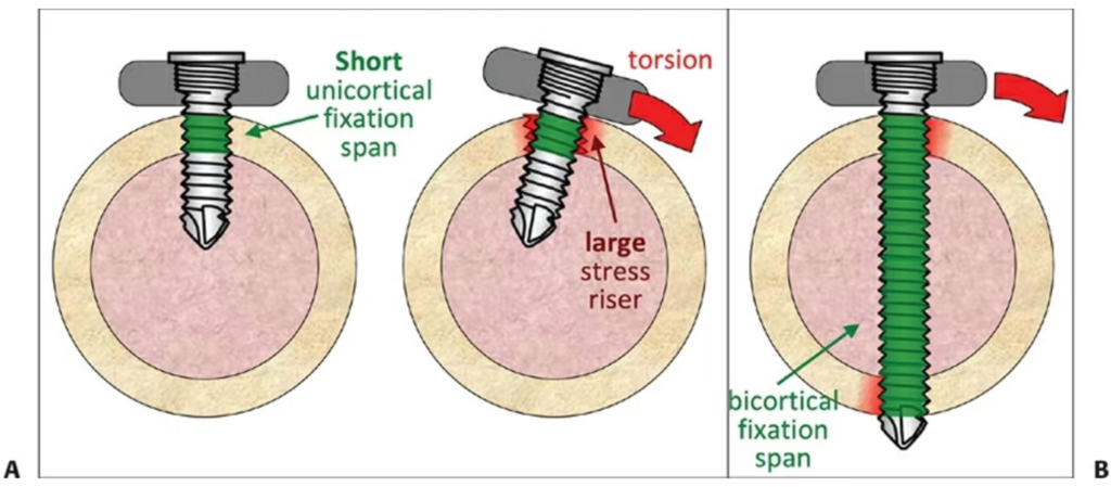 why fixation span matters in fracture fixation and how plate length, screw distribution, working length, and stress concentration affect construct strength.