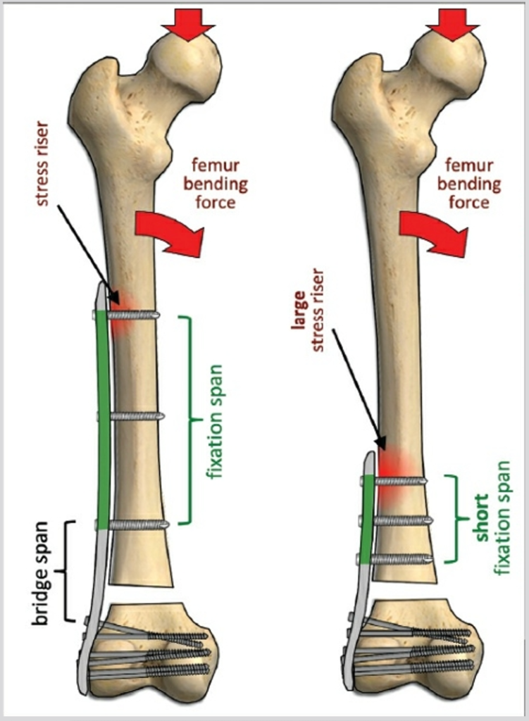 Long and short fixation spans in distal femoral plate constructs, showing screw distribution and terminal screw stress concentration.