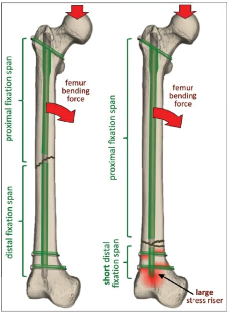 Femoral intramedullary nail diagrams comparing midshaft and distal fractures, with a short distal fixation span and stress concentration.