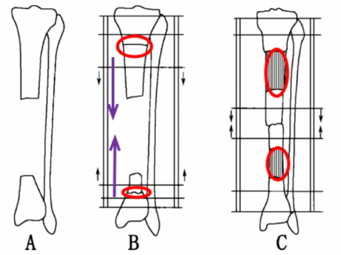Two bone segments move toward a central tibial defect, with new bone forming behind each segment