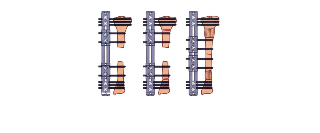 Bone transport stages showing a tibial defect, movement of living segments and new bone formation