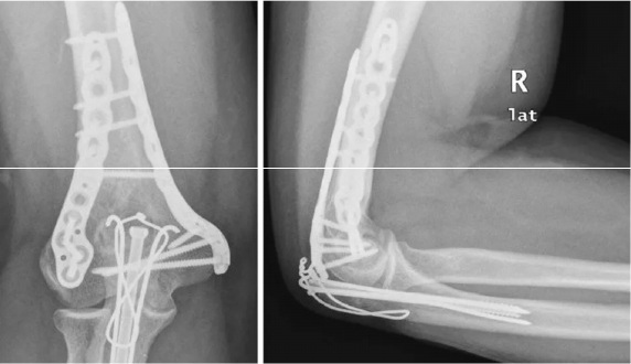 Front and side radiographs showing orthogonal dual-plate fixation at the distal humerus.