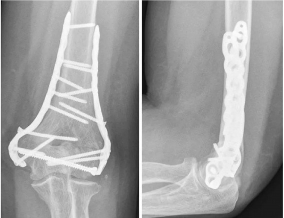 Front and side elbow radiographs showing parallel dual-plate fixation of a distal humerus fracture.