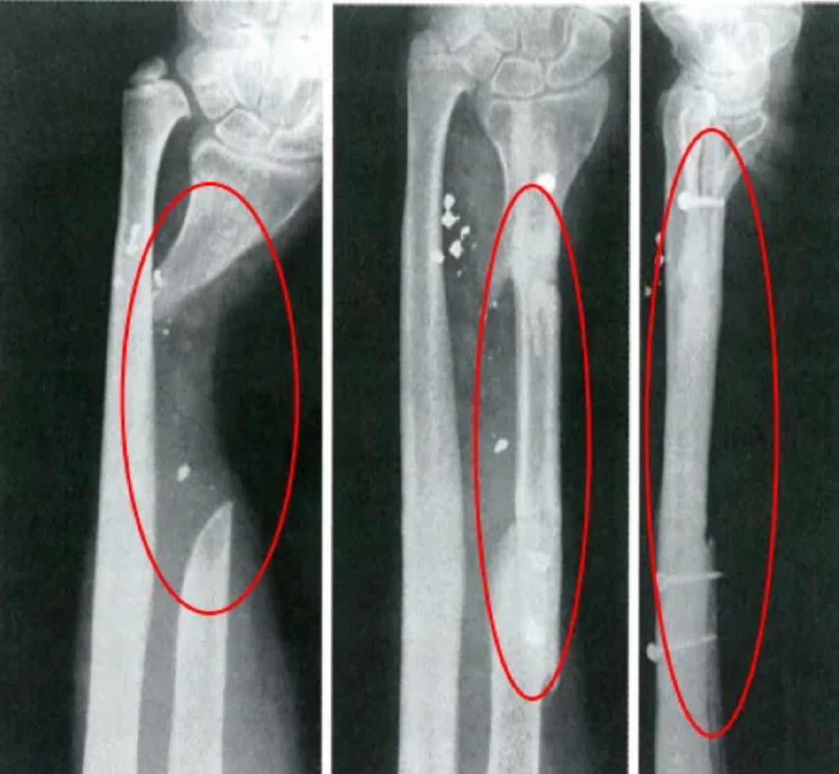 Forearm bone defect radiographs illustrating reconstruction with a fibular autograft