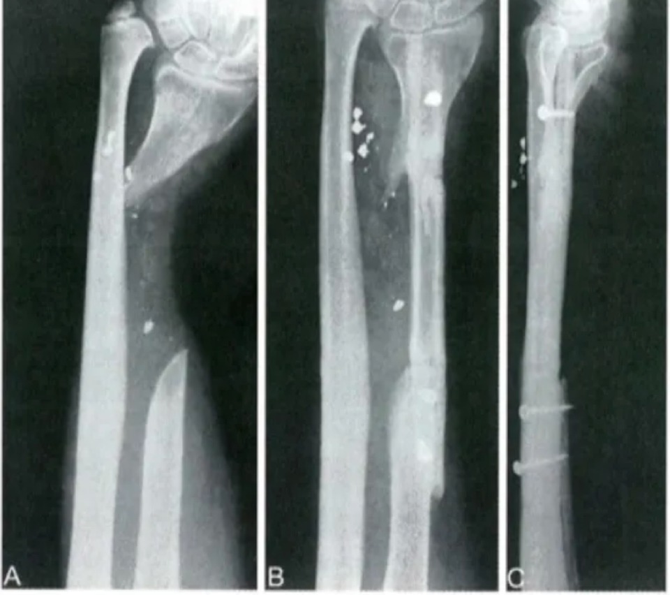 Three forearm radiographs illustrating a nonvascularized fibular autograft case from the source article.