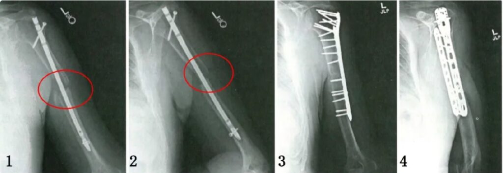 Humeral nonunion radiographs showing nail fixation and subsequent plate-based reconstruction