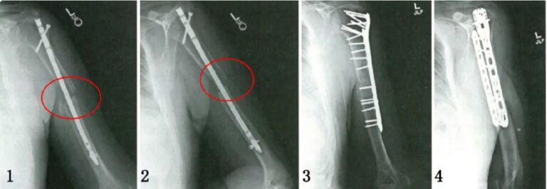Humeral nonunion radiographs showing nail fixation and subsequent plate-based reconstruction