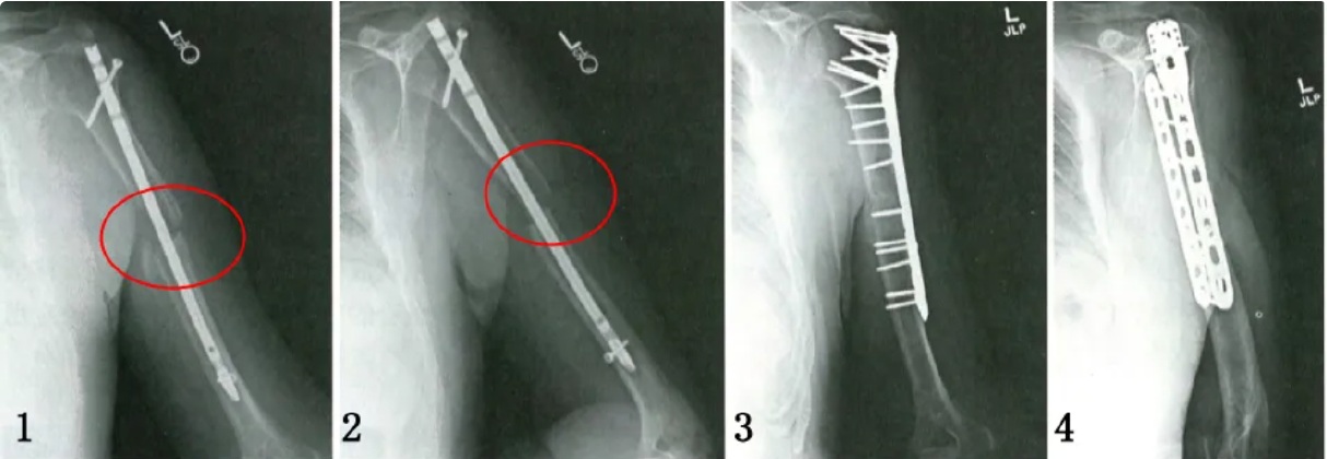 Humeral nonunion radiographs showing nail fixation and subsequent plate-based reconstruction