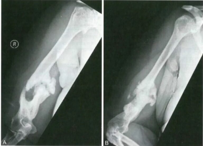 Two radiographic views of humeral nonunion with prominent callus from the source article.