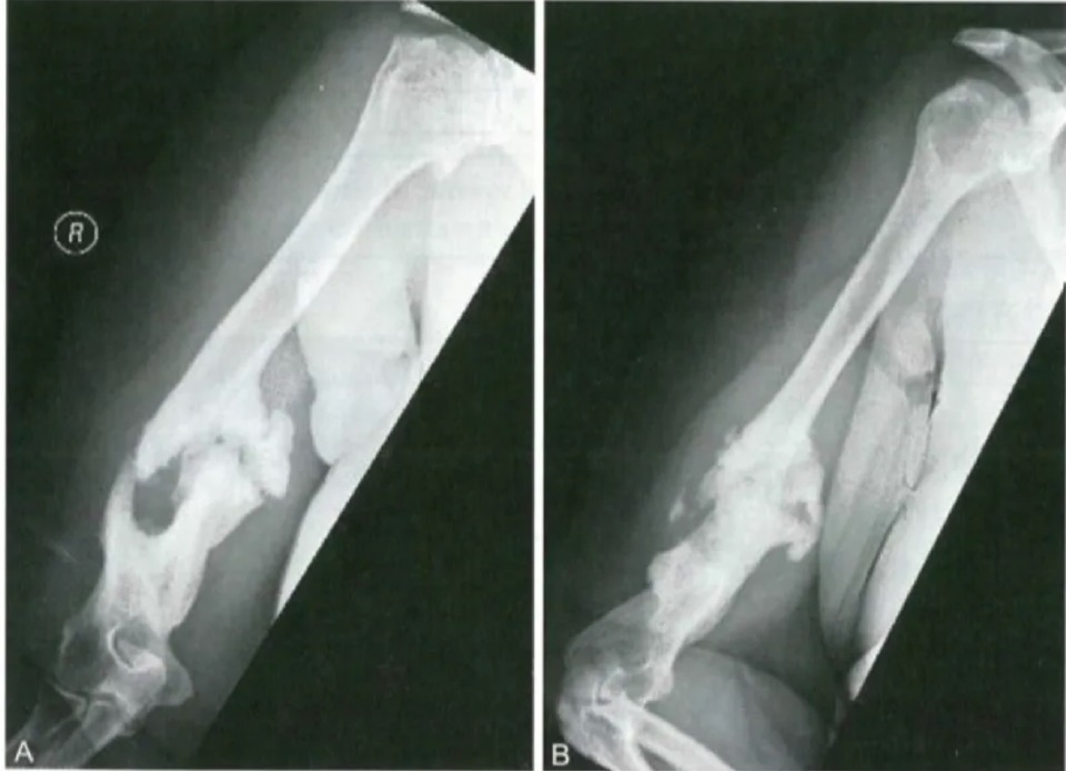 Two radiographic views of humeral nonunion with prominent callus from the source article.