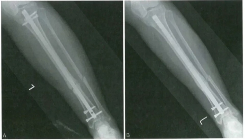 Tibial radiographs showing the source case before and after intramedullary nail exchange.
