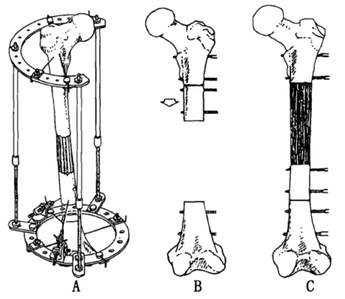 Circular external frame supports a long bone while a living segment moves across a defect