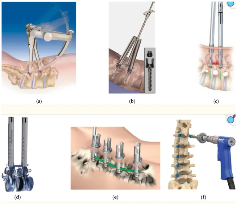 Percutaneous pedicle screw placement instruments and fixation systems illustrated in the supplied source.